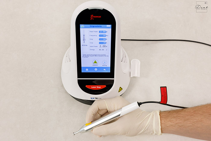 Laser dentar